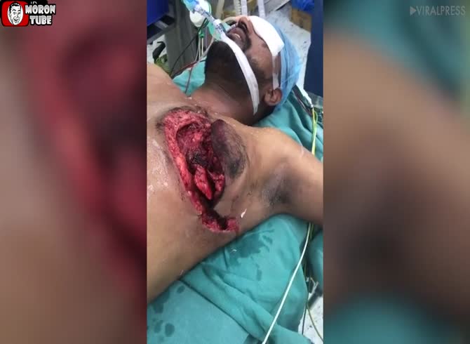 Video :Following a terrible car accident, a portion of the chest was torn off (Public Averti)